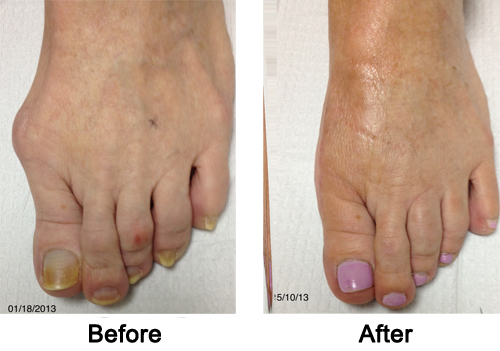 Cosmetic Foot Surgery Before and After 2