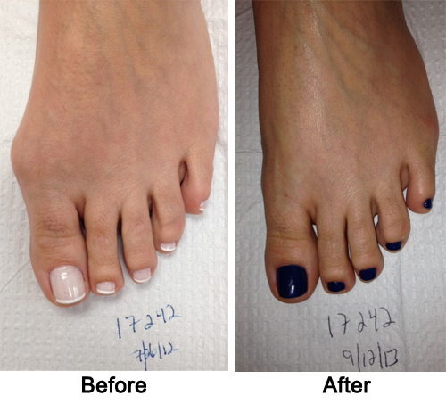 Cosmetic Foot Surgery Before and After 1