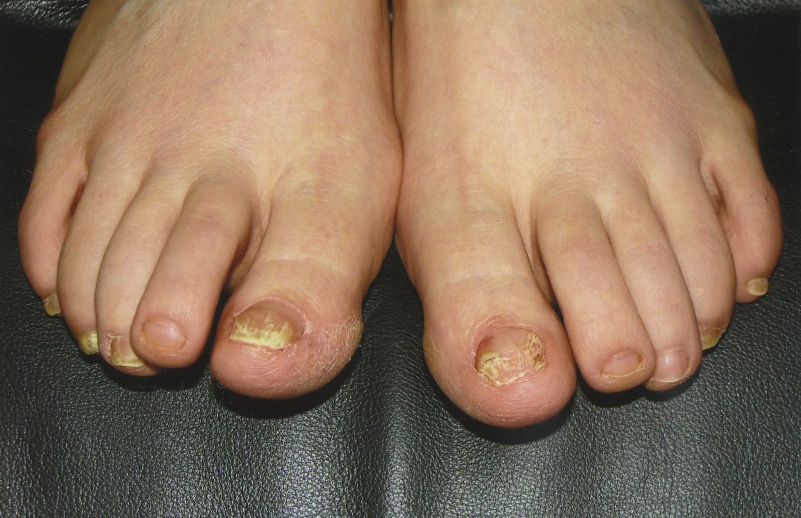 Before the laser treatment for toenail fungus