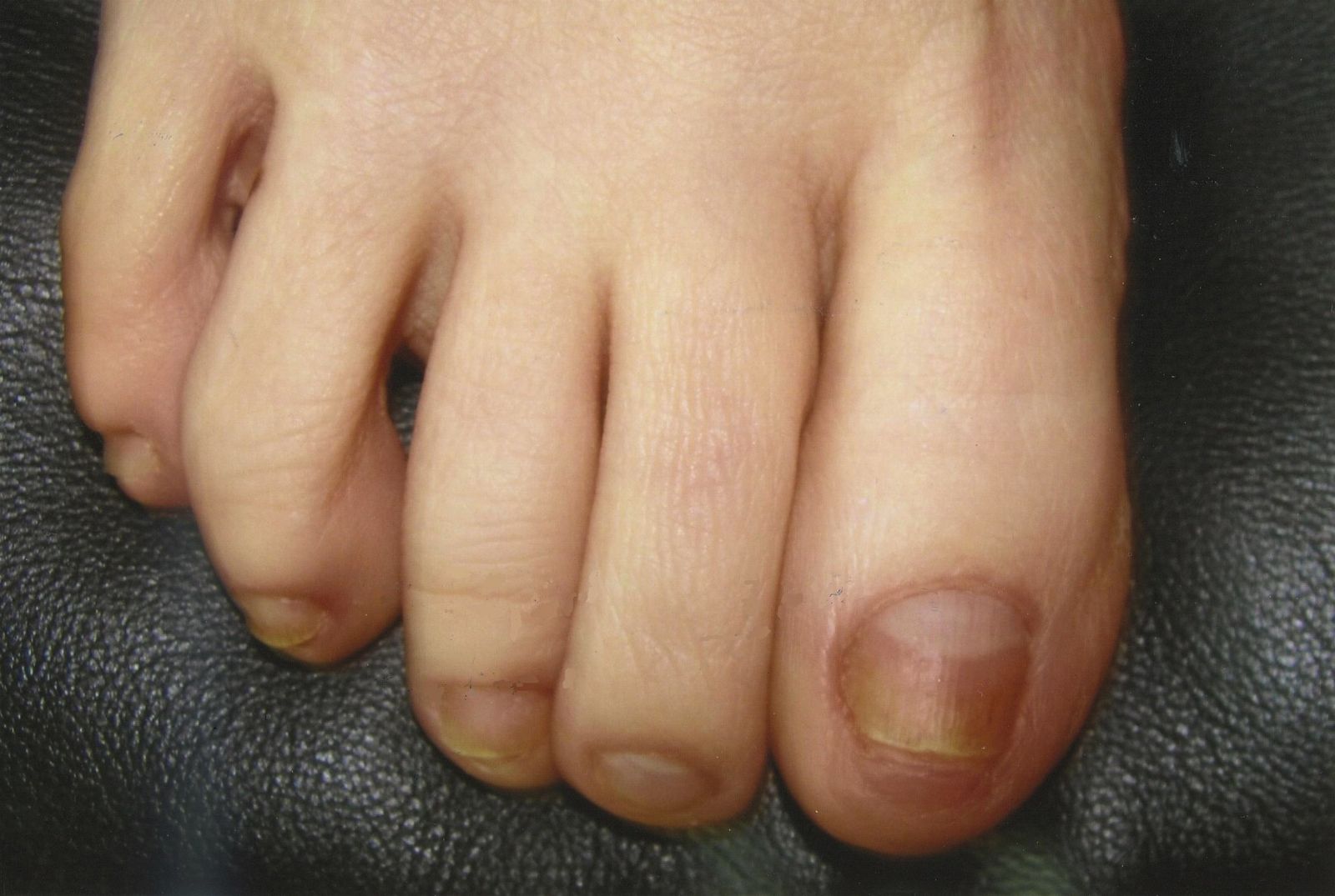 Three months after the laser treatment for toenail fungus