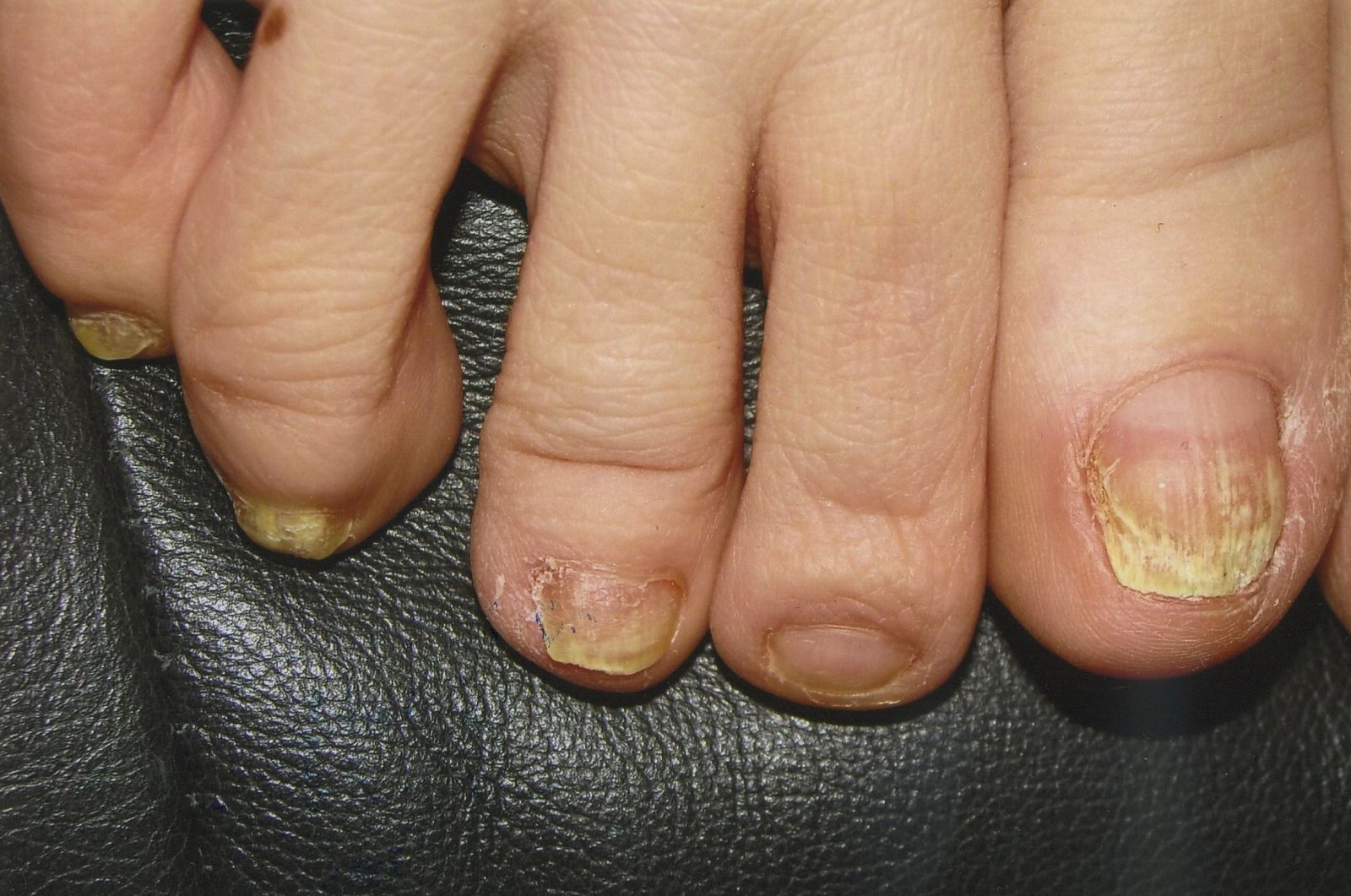 Before the laser treatment for toenail fungus